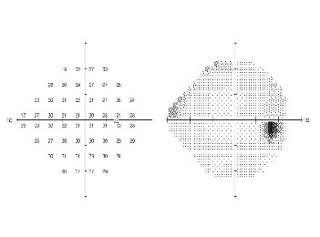 Visual Field Testing Data